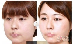 上海下颌角磨骨手术安全吗？下颌角磨骨手术恢复期是多久？