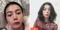 深圳切开双眼皮多久能二
