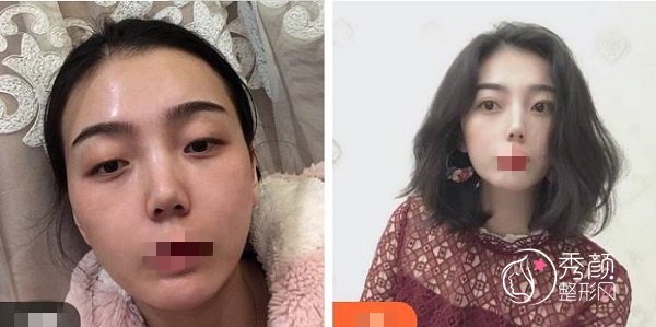 深圳切开双眼皮多久能二次修复？半年之后，附切开双眼皮修复案例