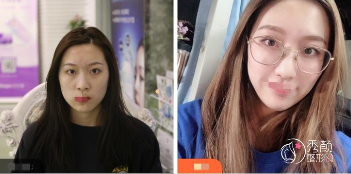上海填充太阳穴凹陷脂肪能保持多久？通常能保持5~10年，内含参考价格