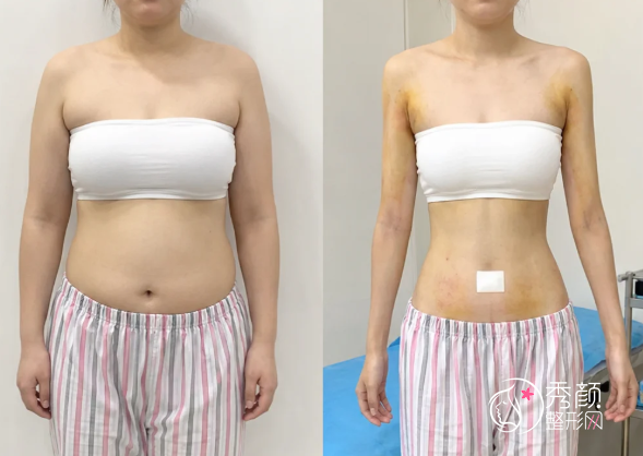 南京抽脂手术哪家做得好？省人民医院|艺星|康美等医院吸脂介绍
