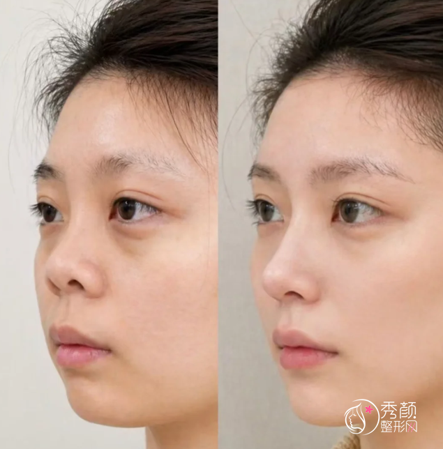 十鼻九修，隆鼻真的别瞎选！4招教你筛出真正的do鼻大佬！
