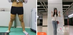 南京腰腹环吸大概多少钱？南京腰腹环吸哪家整形医院做的好？