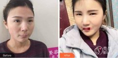 郑州脸部自体脂肪填充价格多少钱？郑州脸部自体脂肪填充哪家医院做