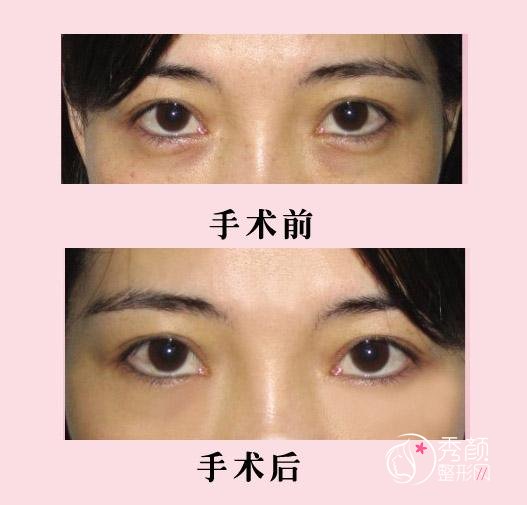 眼袋抽脂是怎么做的？深圳眼袋抽脂技术好的医院有哪些？