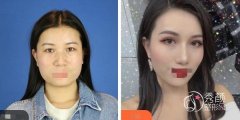 全切双眼皮恢复期多久？大连全切双眼皮哪家整形医院做的好？