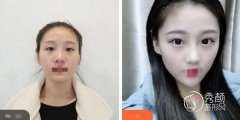刁志勇双眼皮做的好吗？做的好，内含双眼皮案例&坐诊机构一览