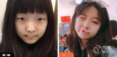 什么叫埋线双眼皮？郑州埋线双眼皮哪家医院好？