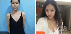 隆胸有几种方式？石家庄隆胸哪家好？省人民医院等荣誉上榜