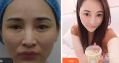 吉大一院张舵修复双眼皮吗？当然，可以修复过宽、过窄、不对称等问