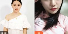 濡白天使隆鼻会移位吗？杭州濡白天使隆鼻多少钱？