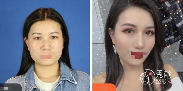 周一雄双眼皮修复怎么样？内含医生简介&双眼皮修复案例