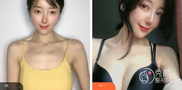 乳头缩小手术方法有哪几种？佛山乳头缩小手术哪家强？