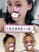 下颌角截骨手术恢复期多久？成都下颌角截骨哪家好？