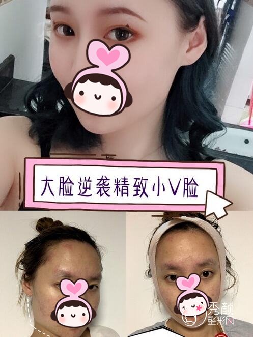 下颌角截骨手术恢复期多久？成都下颌角截骨哪家好？