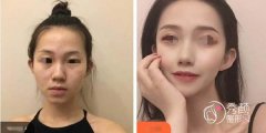 玻尿酸注射鼻子会变宽吗？沈阳玻尿酸注射鼻子哪家好？
