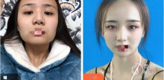 下颌骨一高一低脸歪怎么矫正？杭州下颌骨一高一低脸歪矫正哪家好？