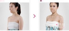 娜高假体隆胸好不好？南昌娜高假体隆胸哪家好？