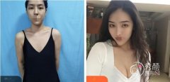 假体隆胸后多久胸部才柔软自然？宁波假体隆胸哪家医院做的好？