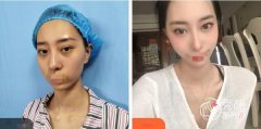 武汉热玛吉五代全脸做一次多少钱？1万元起，欧燕、华美等实力强