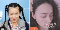 上海雍禾植发跟大麦微针植发哪个好？从核心技术、费用收取等来对比