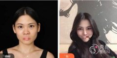 鼻子打玻尿酸会好看吗？大连玻尿酸隆鼻哪家技术好？