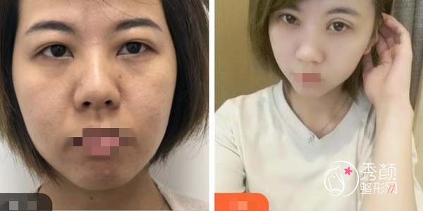 济宁刘郭割双眼皮怎么样？口碑出众，审美偏妈生感，内含双眼皮案例