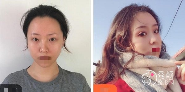 刘月丽和杨丽谁做双眼皮更好些？初眼整形选刘月丽，眼修复选杨丽