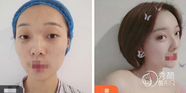 脂肪填充眼窝能维持多久？沈阳脂肪填充眼窝哪家医院做的好？