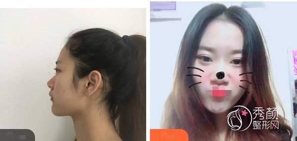 膨体隆鼻恢复时间有多久？成都膨体隆鼻哪家医院技术好？