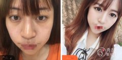 唐都医院去眼袋靠谱吗？靠谱，陈辉、孙超锋医生介绍，内含案例展示