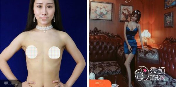 广州珠江医院丰胸手术费用多少钱？参考1万元起，陈伯华、陈兵技术强