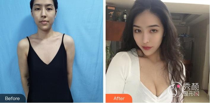 假体隆胸的材料品牌有哪些？杭州假体隆胸哪家医院好？