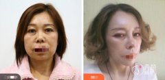 西安拉皮手术哪位医生做得好？西安拉皮常见的美容方式介绍