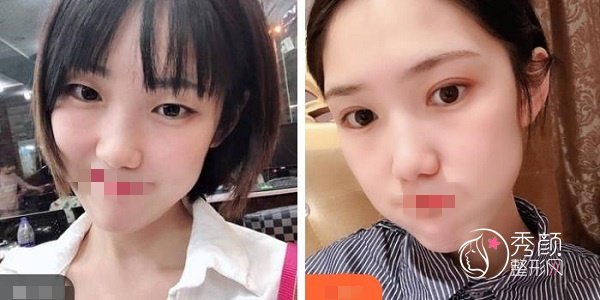 胜利油田中心医院双眼皮怎么样？杨晓笛、辛志明技术强，内含案例展示