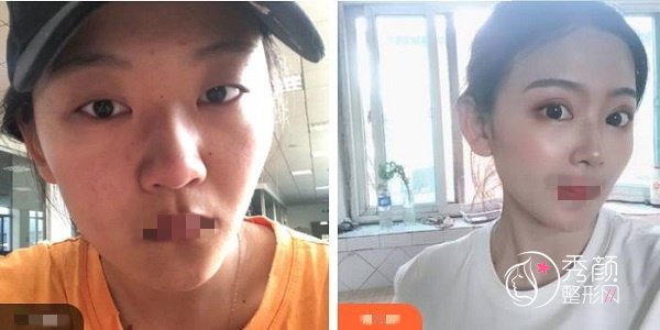 蚌埠三院割双眼皮怎么样？口碑好、技术稳妥，章祥洲‌&刘金凤操作实力强