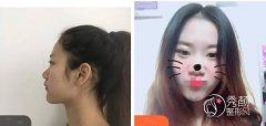 西京医院隆鼻好的医生是谁？宋保强、彭湃实力强，内含隆鼻案例展示