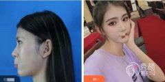 厦大附一院隆鼻多少钱？