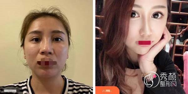 云南省第一人民医院隆鼻多少钱？玻尿酸隆鼻3千元起，内含专家介绍