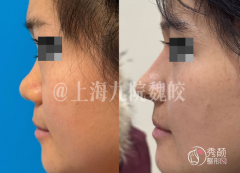 上海九院隆鼻多少钱？上海九院隆鼻价格表+隆鼻医生整理
