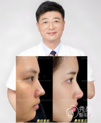 北京隆鼻哪个医生好？李劲良、巫文云、刘彦军实力太夯！