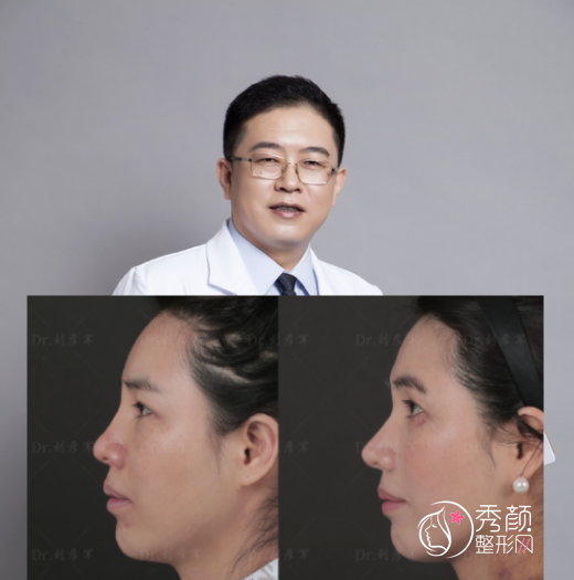 北京隆鼻哪个医生好？李劲良、巫文云、刘彦军实力太夯！