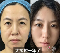 沈阳做拉皮手术最